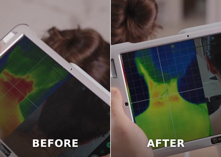 Two ThermPix scans of the same patient’s upper back, taken before and after a period of care